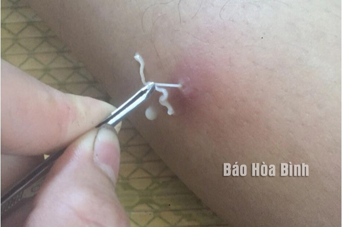 Giám sát ca bệnh nhiễm giun rồng tại thành phố Hòa Bình