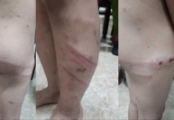 Phú Thọ: Công an điều tra vụ cháu bé 11 tuổi nghi bị mẹ ruột và bạn trai bạo hành