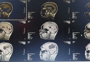 Phẫu thuật ổ sán não khổng lồ trong não nam bệnh nhân