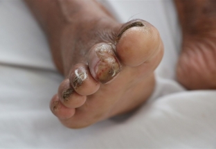 Thêm một người bệnh nhiễm whitmore từ vết lở loét ở ngón chân