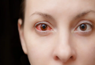 Những bệnh nhiễm trùng mắt liên quan đến COVID-19