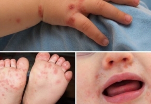Không nên hoang mang việc thiếu thuốc điều trị bệnh tay chân miệng ở trẻ em