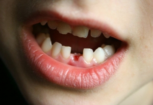 Những điều cần biết về chăm sóc sức khoẻ răng miệng cho trẻ em