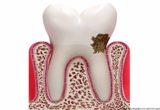 Những nguyên nhân phổ biến gây các vấn đề về răng miệng